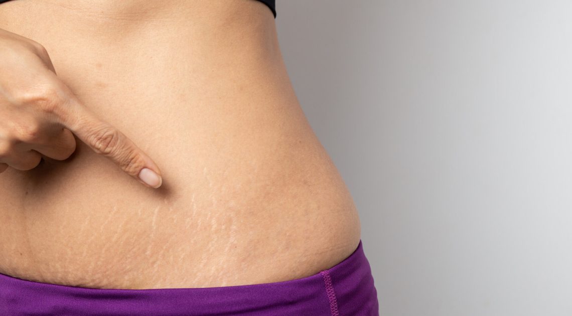 women-show-off-belly-after-birth-stretch-marks-white-background